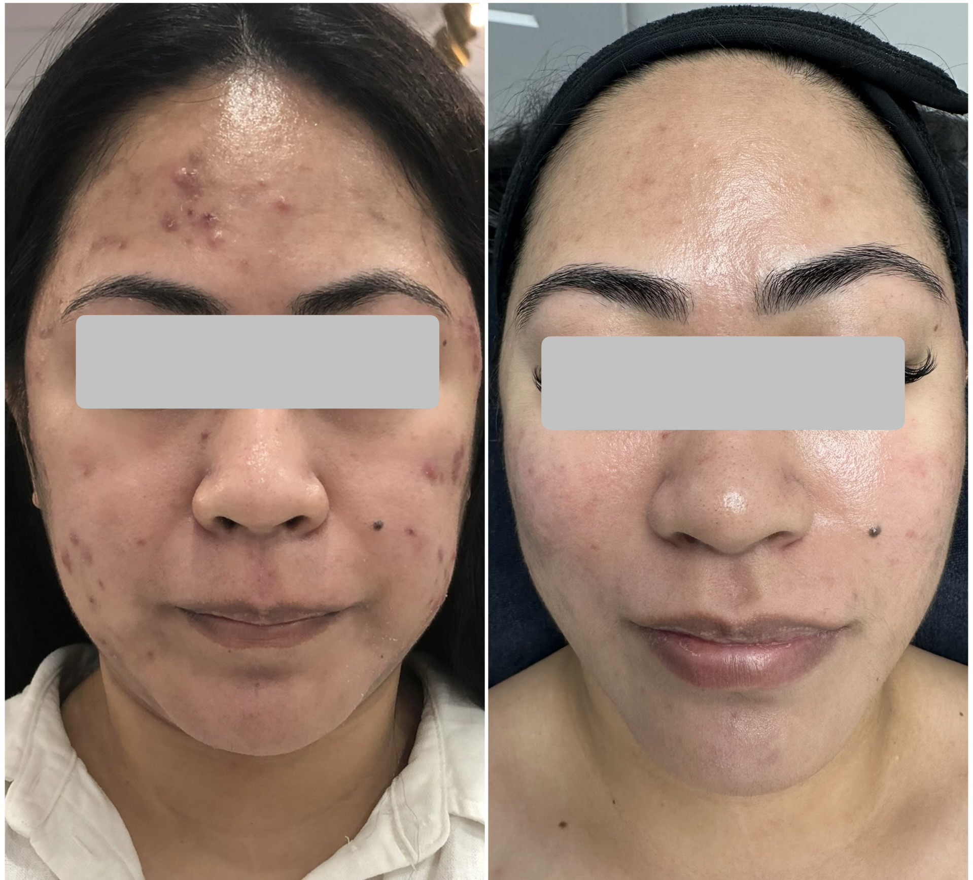 Acne Laser Before and After