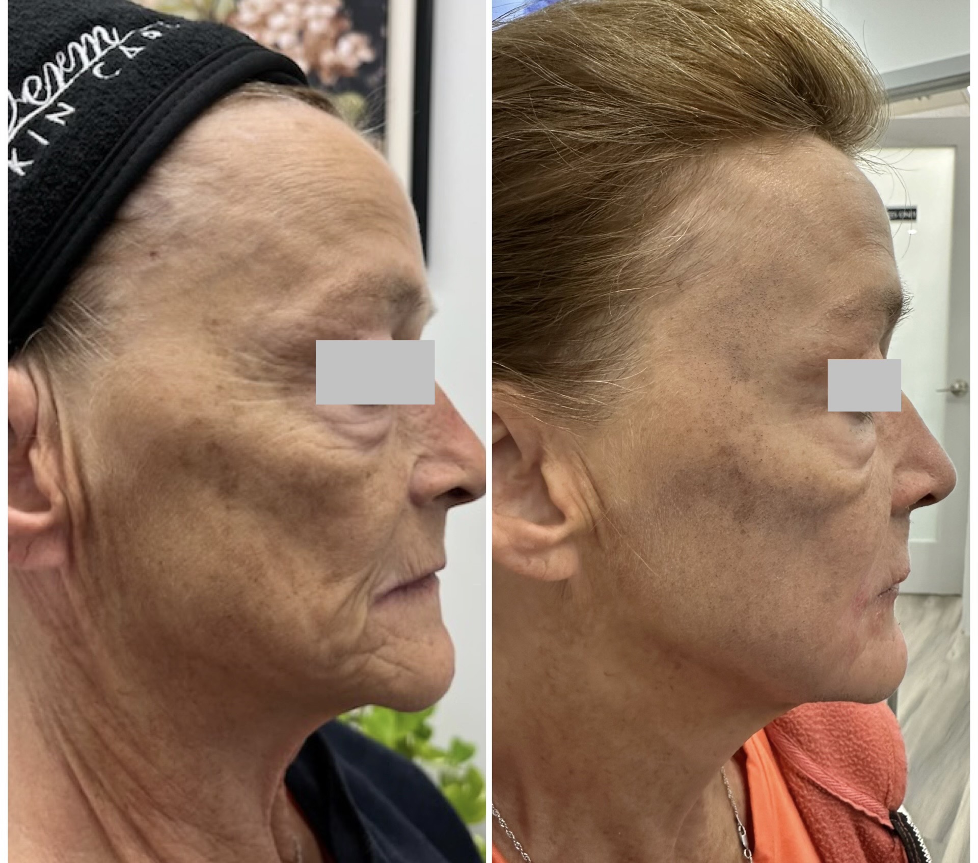 Alma Hybrid Before and After