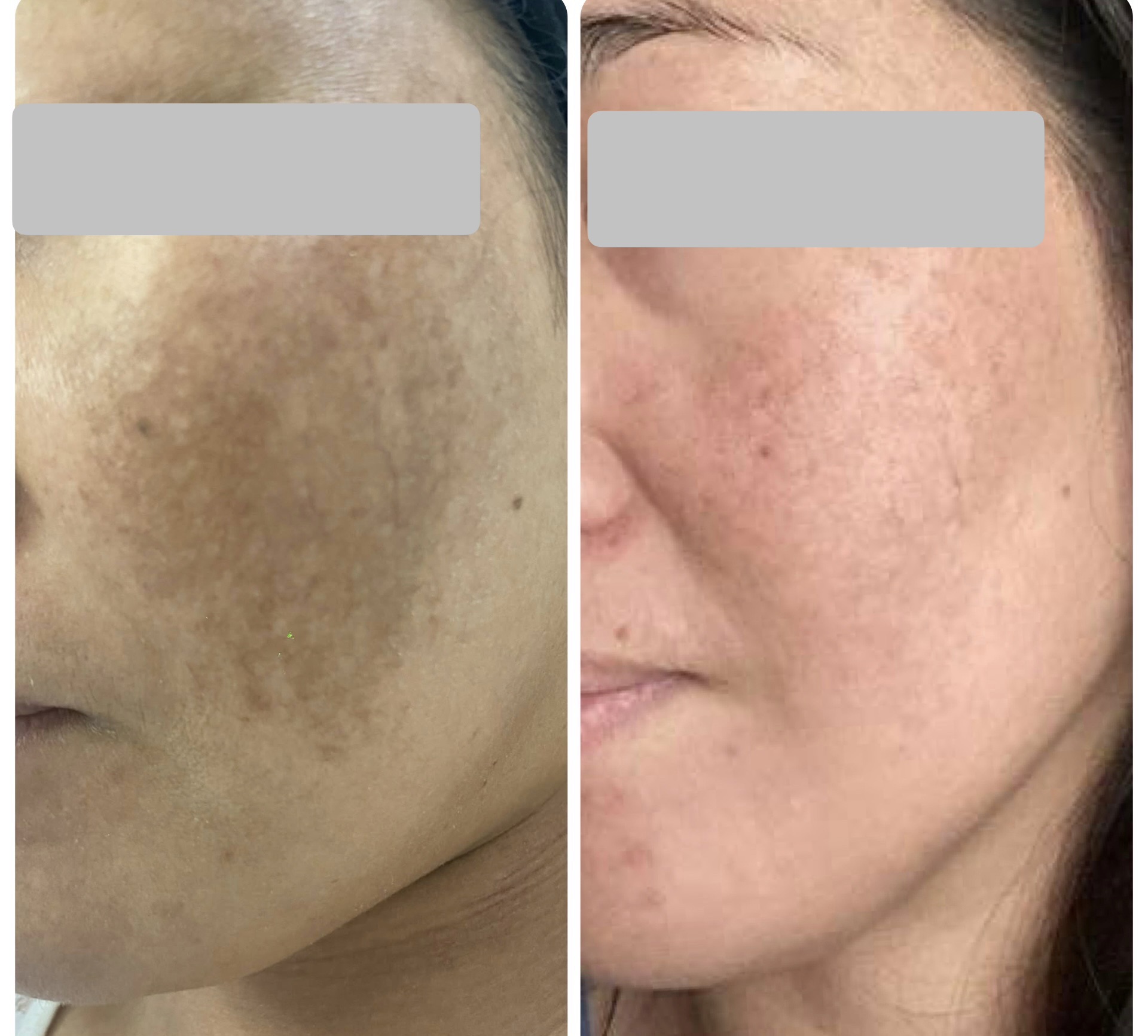 Melasma Laser Before and After